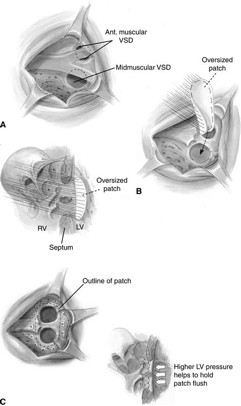 Operative Techniques for Repair of Muscular Ventricular Septal Defects