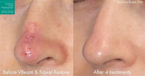 Before and After Photos San Diego, CA | Cosmetic Dermatology