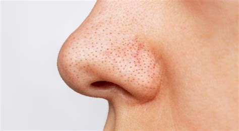 Nose Blackheads: Tips on How to Get Rid of Them | Healthnews