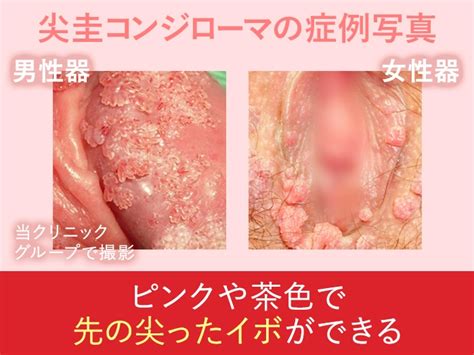 尖圭コンジローマの検査・治療|池袋マイケアヒルズタワークリニック