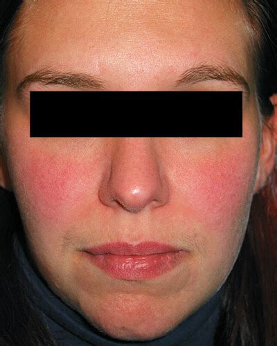 The Many Faces of Rosacea | Rosacea.org