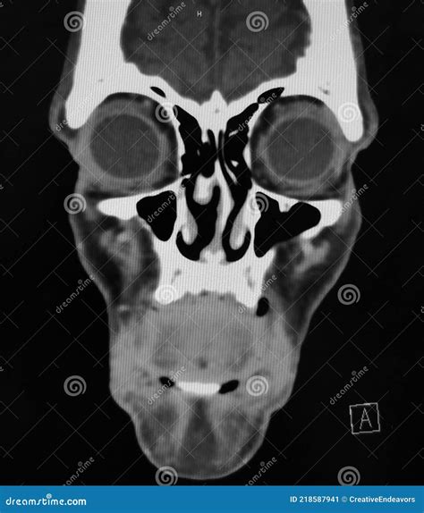 Coronal CT Scan of the Sinuses and Face Stock Image - Image of black ...