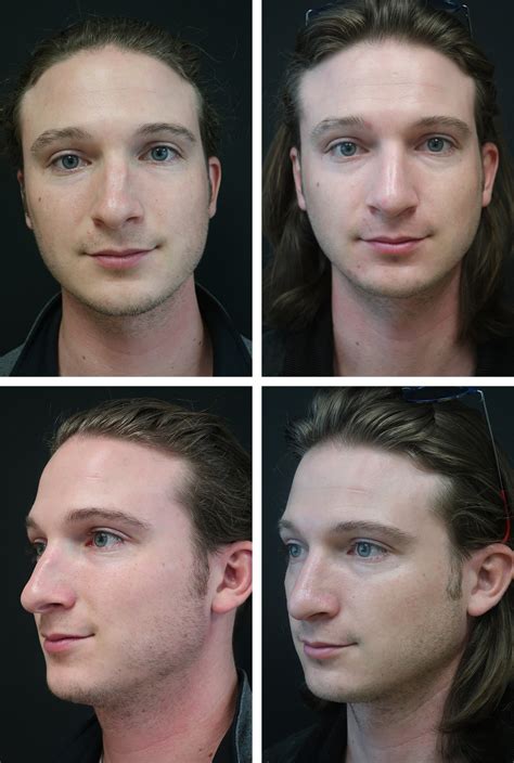 Open Septo Rhinoplasty - Case #73083 - The Plastic Surgery Group