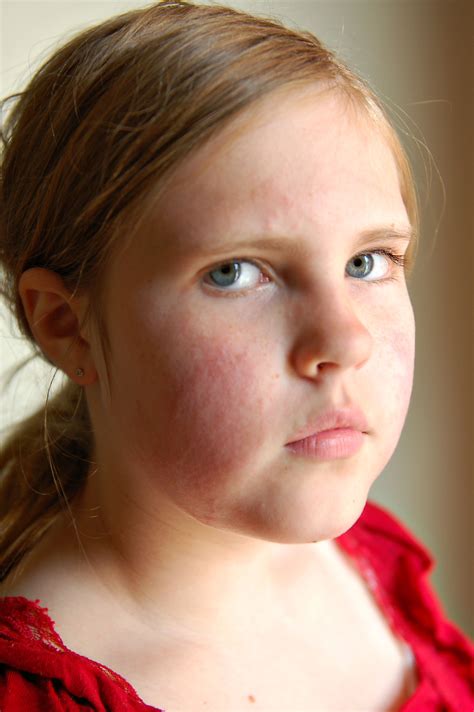 Face Rash With Strep at David Oldham blog