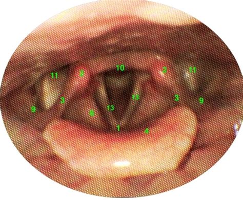 vocal fold anatomy diagram quizlet