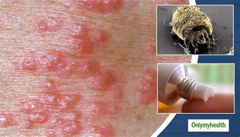 paediatrics   deal  scabies  paediatric age