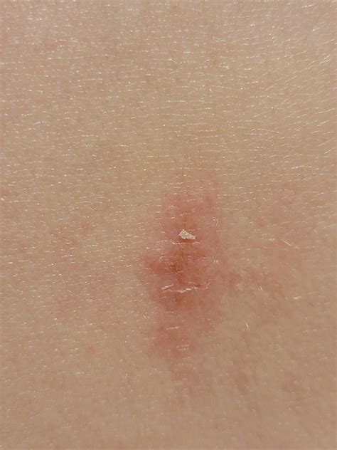 Amelanotic melanoma? : r/Dermatology