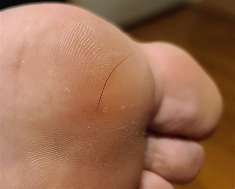 How to Remove a Deep Hair Splinter from Your Foot at Home during ...