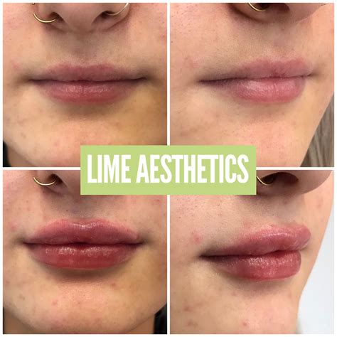 lip line fillers 5