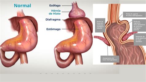 Refluxo Incha A Barriga - Doença do refluxo gastroesofágico: Entenda os sintomas e tratamentos