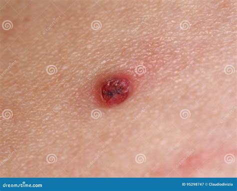 pyogenic granuloma  skin royalty  stock photo cartoondealercom