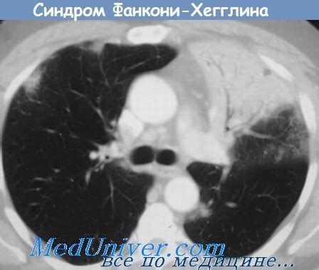 Синдром псевдосифилитический - синонимы, авторы, клиника