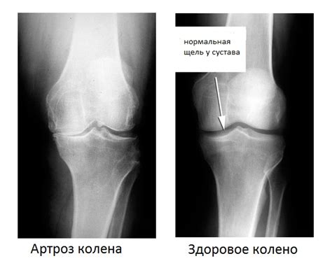 Артроз: симптомы, причины, лечение, профилактика