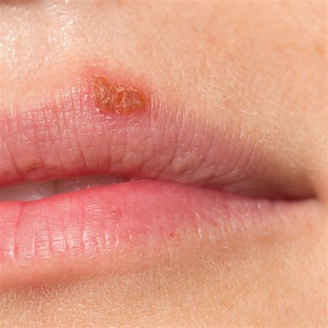 Herpes On The Lips Early Sesame Seeds You - Infoupdate.org