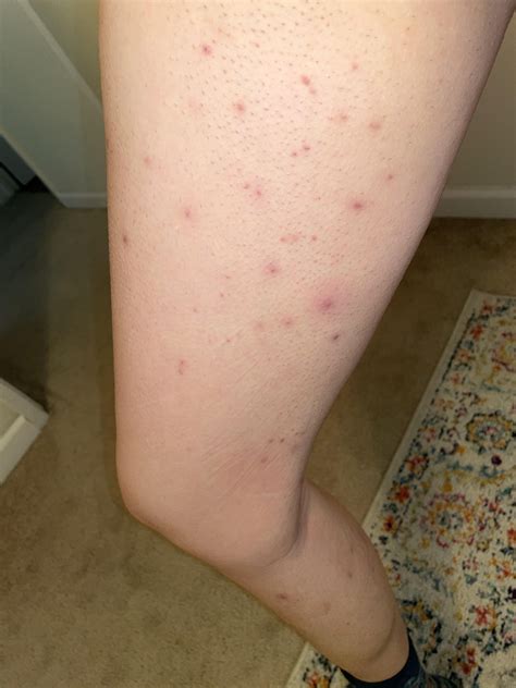 Painful bumps all over legs : r/Folliculitis