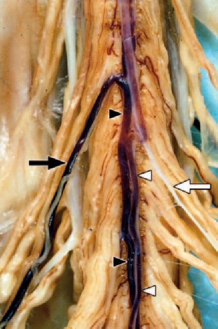 Figure 1 from MR angiography of the great anterior radiculomedullary artery (Adamkiewicz artery ...