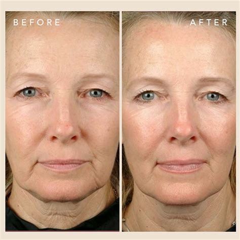 ultraformer nicknamed   surgical facelift oo la la