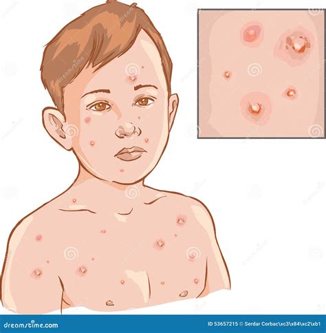 Chickenpox Cartoons, Illustrations & Vector Stock Images - 889 Pictures
