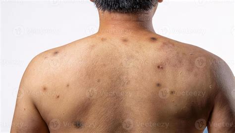liver spots stock  images  backgrounds