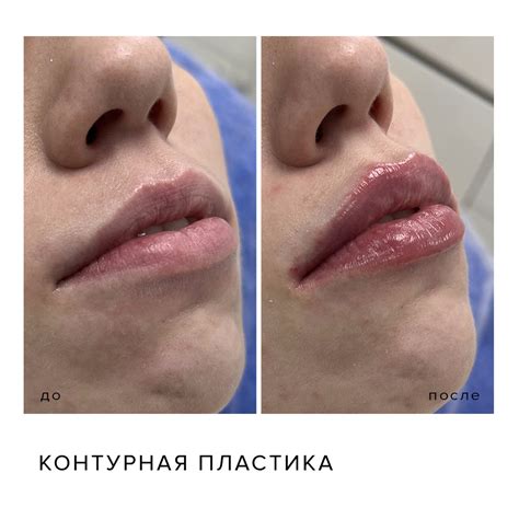 Контурная пластика губ препаратом Stylage S (0,8 мл)