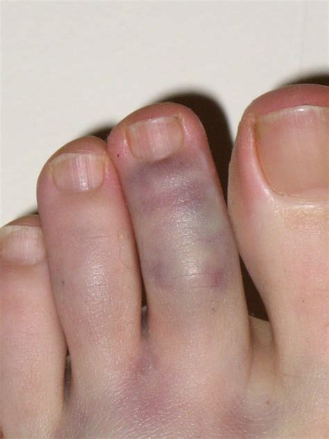 What Does A Broken Toe Look Like at Fred Rollins blog
