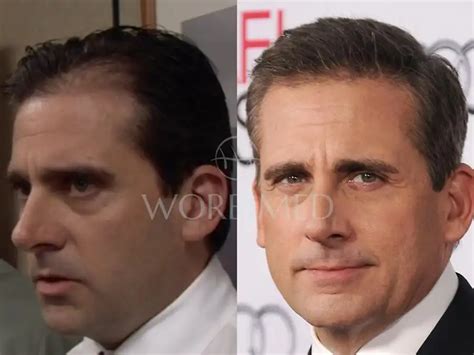 Steve Carell Hair Transplant l Before and After