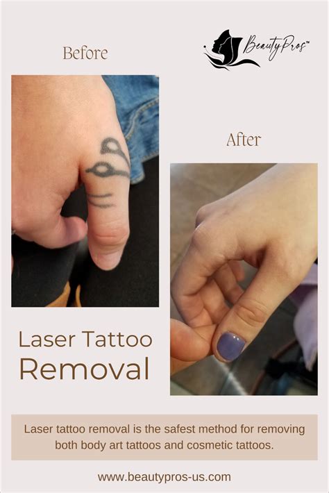 before and after tattoo removal pictures 5