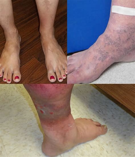 Venous Ulcers & Wound Care for College Park and Waterford Lakes-East