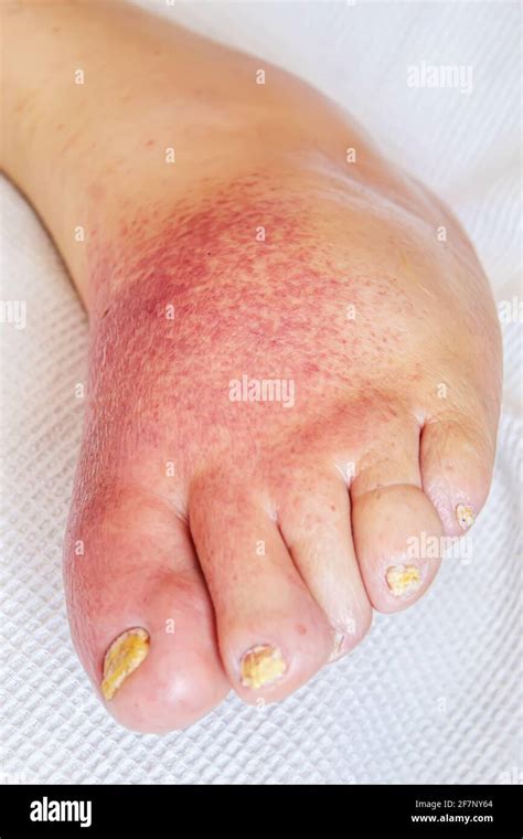 Sepsis skin hi-res stock photography and images - Alamy