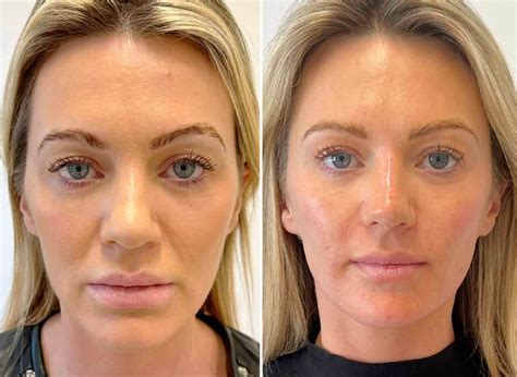 Dermal Fillers | Natural Results | Skin Doctor Clinics