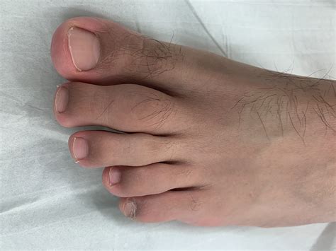 A painful swollen toe | The BMJ