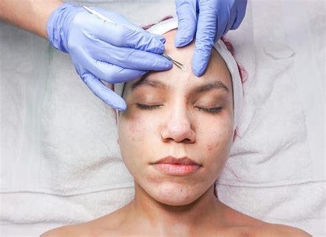 Acne Face Photos, Download The BEST Free Acne Face Stock Photos & HD Images