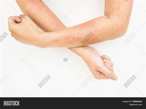 Skin Rashes Allergies Image & Photo (Free Trial) | Bigstock