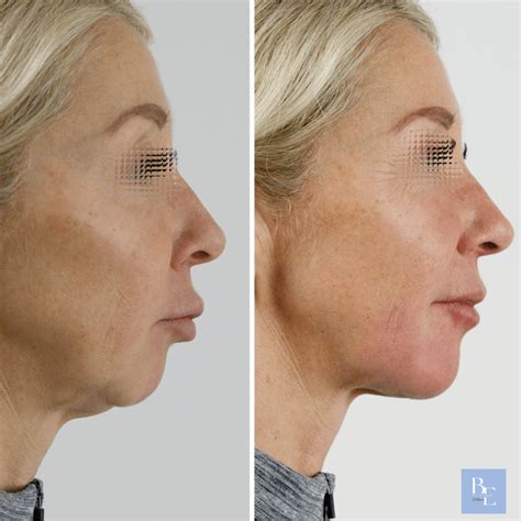 filler mento bellessere