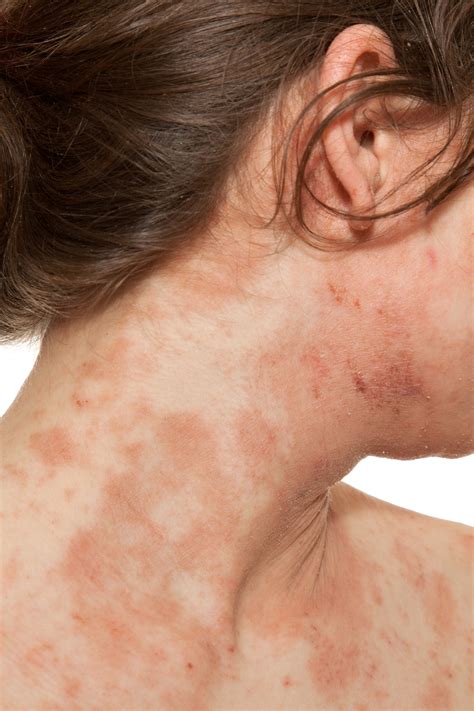 6 Most Common Types of Eczema - Kinds of Eczema and Dermatitis