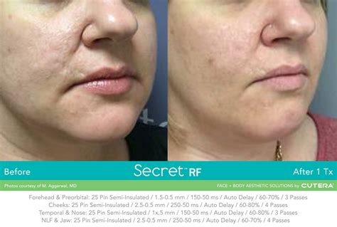 Secret Radio Frequency Microneedling | Dartmouth Dermatology