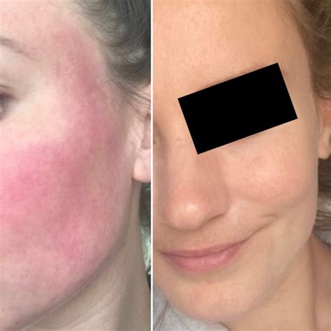 Rosacea Transformation Photos | The Rosacea Method Successes