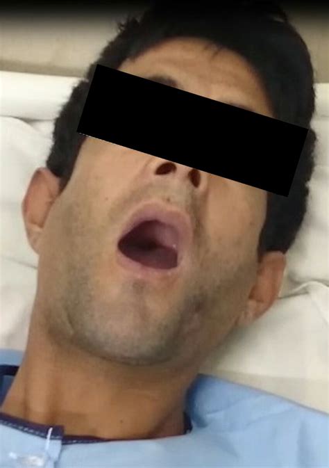 masseter rigidity resulting   inability  move  jaw called