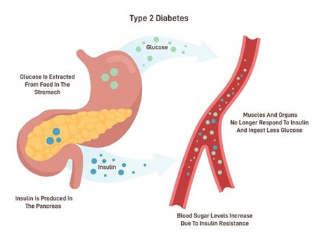 diabetes type  diagram royalty  images stock  pictures