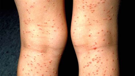 Manchas Na Pele Aids - Erupções cutâneas e condições de pele associadas com HIV e AIDS - Sua ...