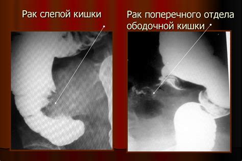 Колоректальный рак - презентация онлайн