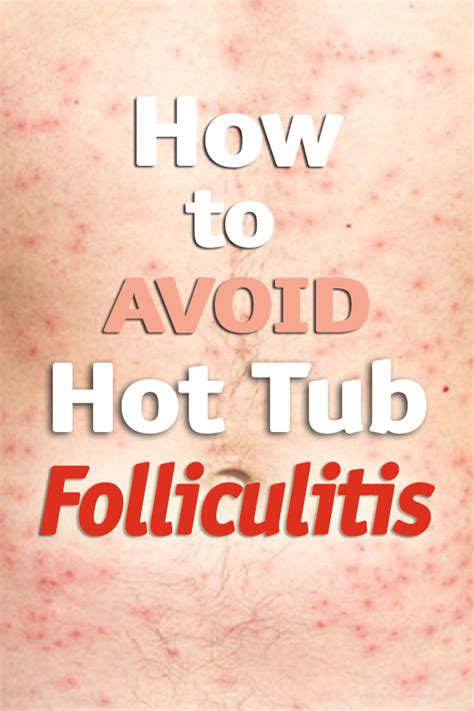 Hot Tub Infection Folliculitis | acsbr-nccsea