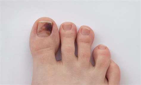 What’s Causing The Black Spot Beneath My Nail? – My FootDr
