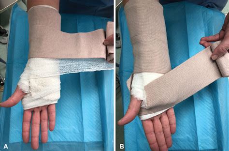 Splinting after Distal Radius Fracture Fixation: A Prospective Cohort