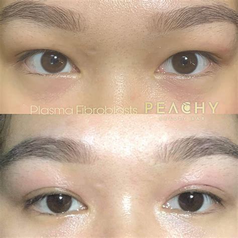 Nano Plasma Aesthetic - Peachy Beauty Bar