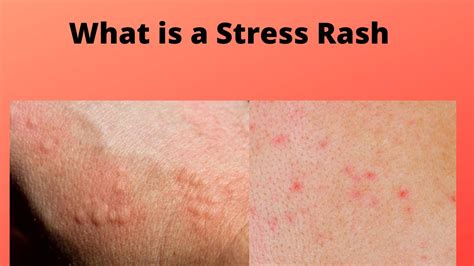 itchy skin rash caused  stress  dylan trouton blog