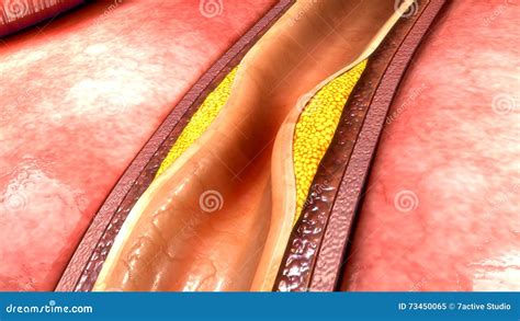 Coronary Artery Plaque Royalty-Free Stock Image | CartoonDealer.com ...