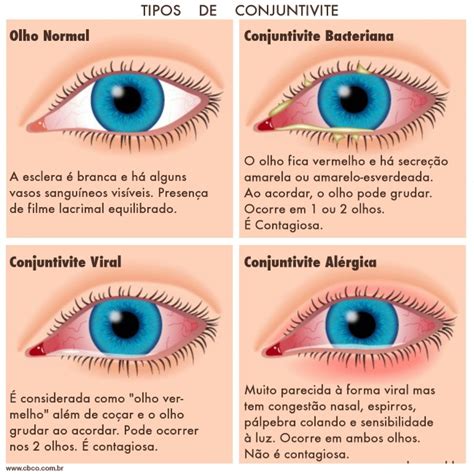 Crianca Com Conjuntivite - Conjuntivite