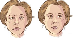 differences  central  peripheral facial palsy