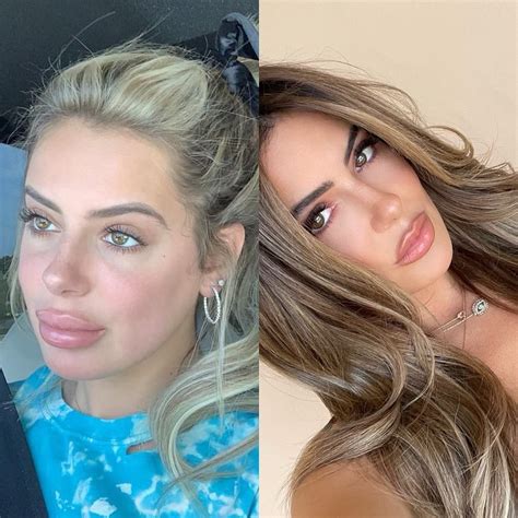 Brielle Biermann warns against getting lips ‘overfilled’ with shocking